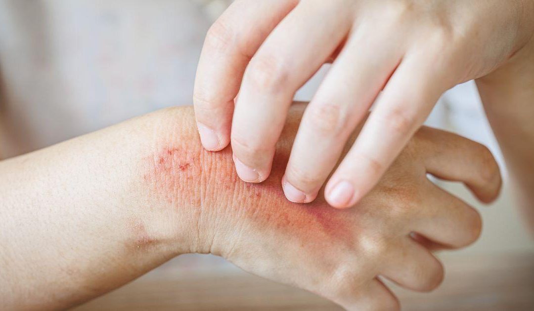 Bőrgomba kezelése házilag – mit tehetünk otthon?