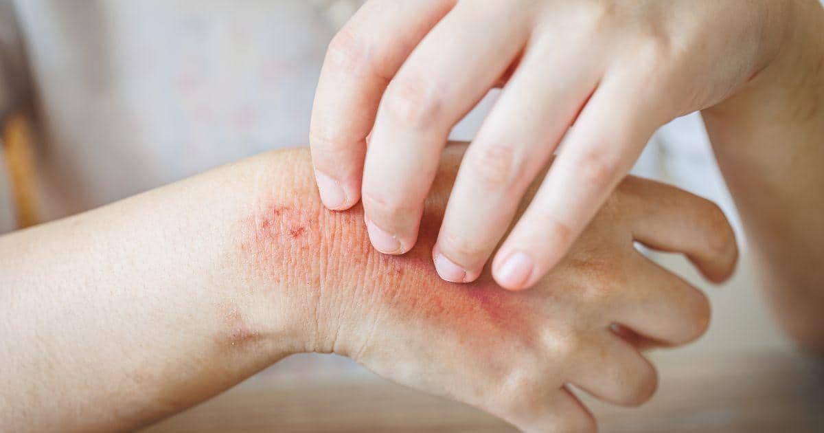 Borgomba kezelese hazilag Bőrgomba