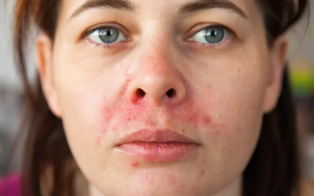 Seborrheás dermatitisz: okai, tünetei és kezelése