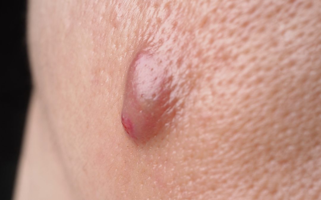 Erythema-nodosum – gyulladt, fájdalmas csomó a bőr alatt: okok, tünetek, kezelés