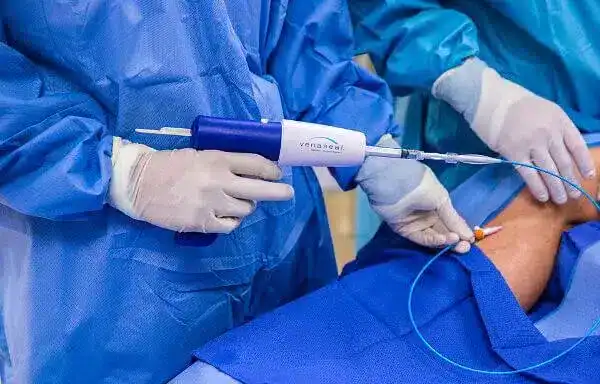 VenaSeal visszérkezelési eljárás
